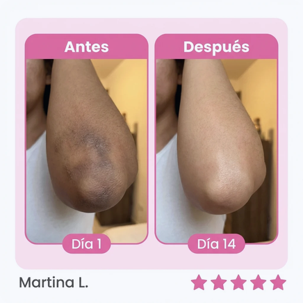 Antes y después — codos